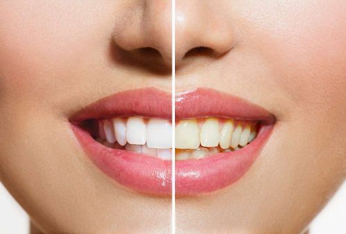 Stained Teeth | 98226 Dentist