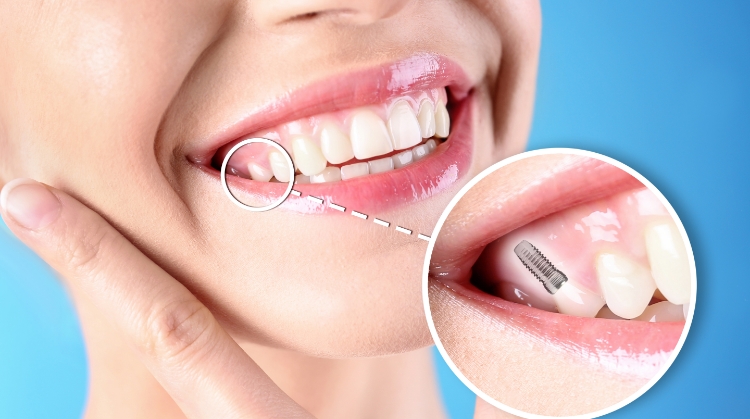 Dental implants shown in a woman's smile with a close-up view.