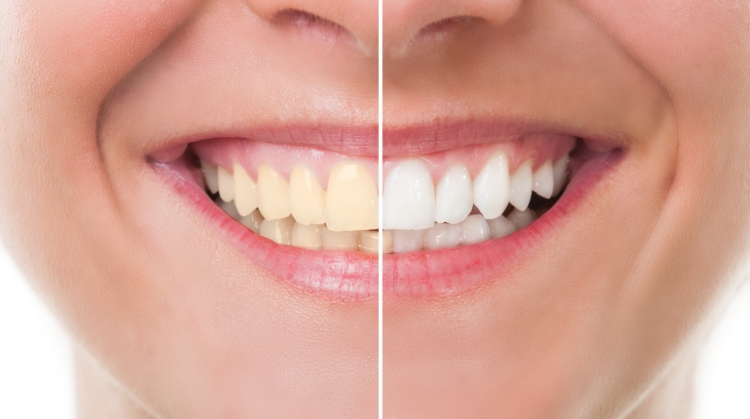 Tips to Keep Your Bright Smile After a Teeth Whitening Treatment