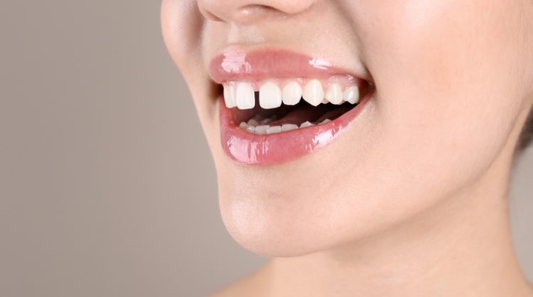 How to Fix Gaps Between Teeth Without Braces