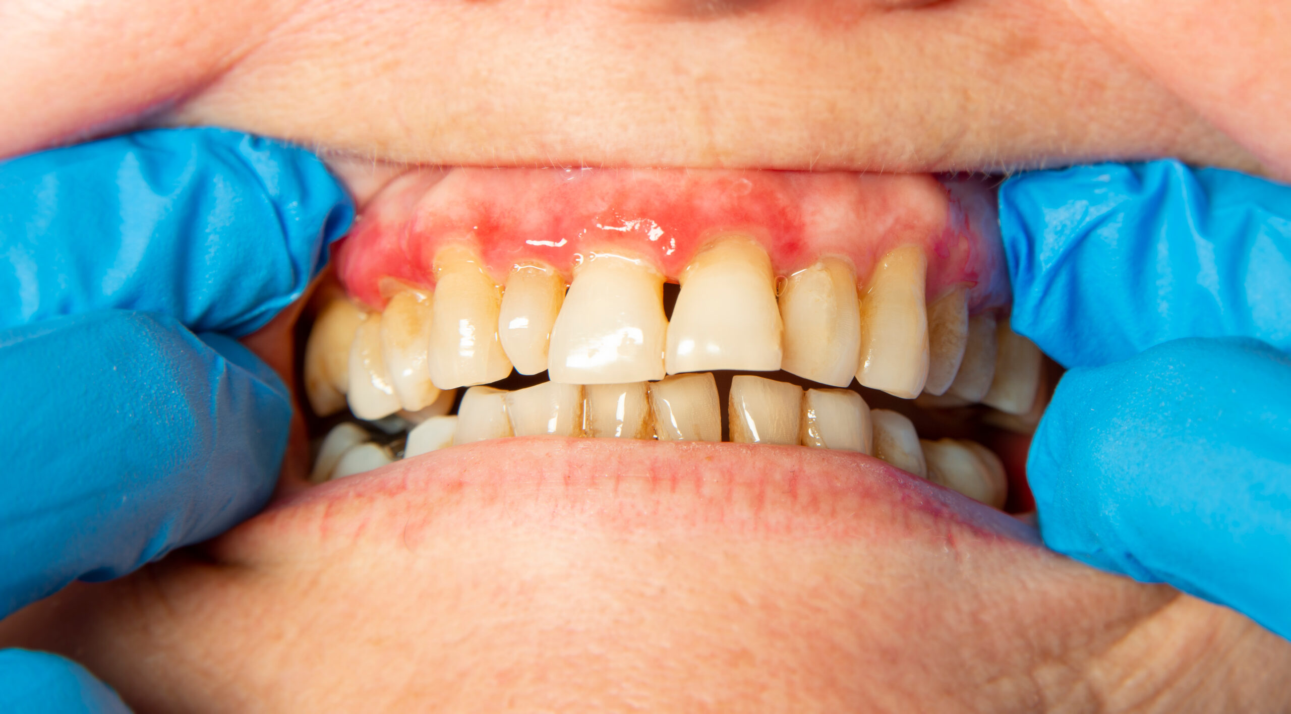 How to Prevent Gum Disease Before It Starts