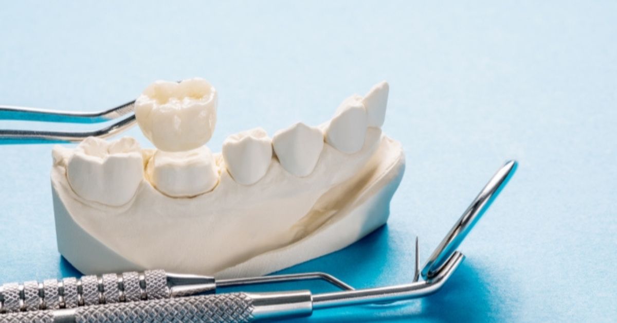 how long do dental crowns last