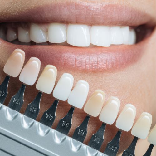 Porcelain Veneers vs Composite: Which Is Right for Your Smile?