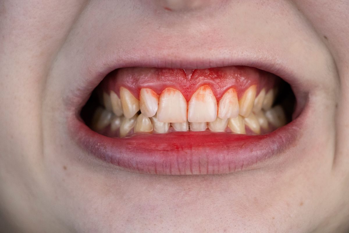 7 Reasons Why My Gums Bleed and How to Fix It