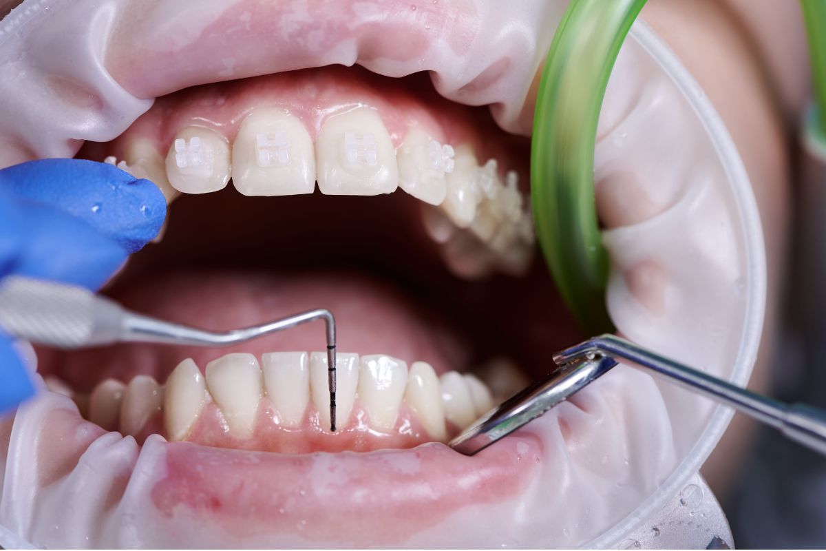 What to Expect During a Dental Cleaning: Bellingham Dentists Provide