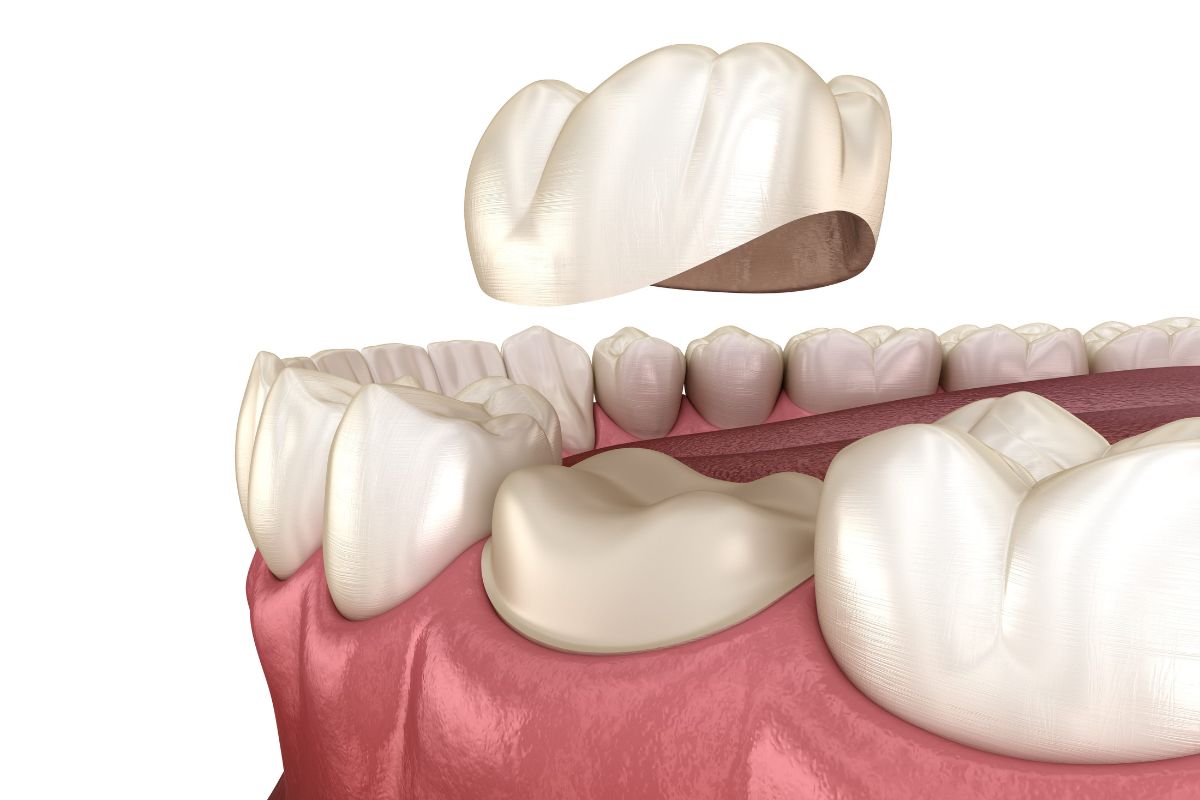 What Is the Difference Between a Dental Crown vs Filling for Tooth Decay?
