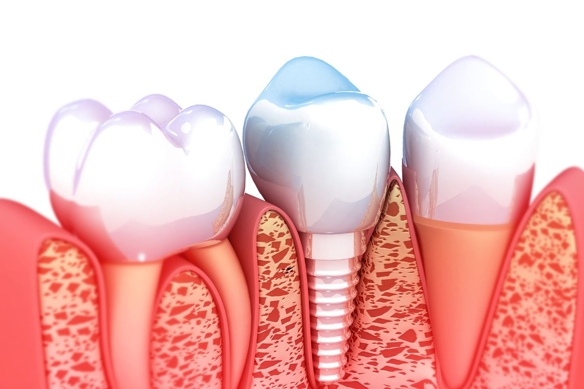 Is It Normal to Experience Pain During the Dental Implant Healing Stages?